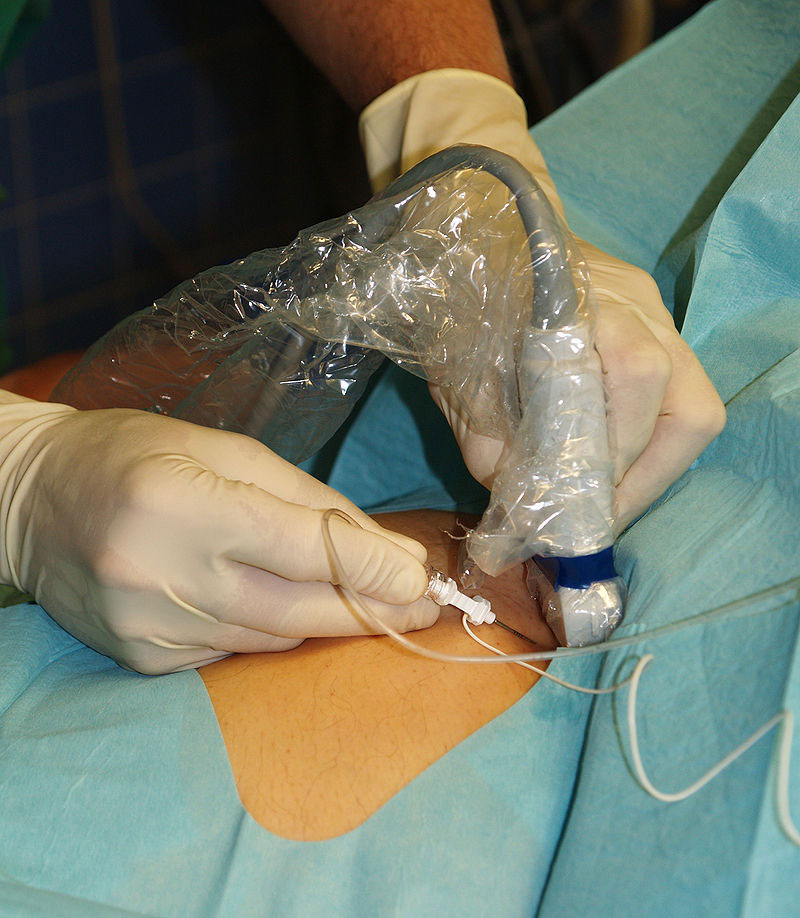 Sonography-guided-femoral-nerve-block